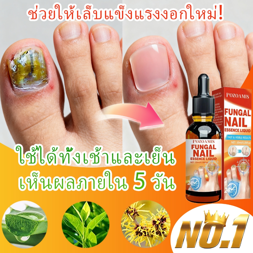 เซรั่มเชื้อราเล็บ ฆ่าเชื้อเชื้อราที่เล็บ ซ่อมแซมเล็บที่แตกและเปราะ รักษาเชื้อราที่เล็บ และช่วยบํารุงเล็บ เงางาม