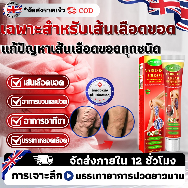 【นำเข้าจากอังกฤษ】ครีมรักษาเส้นเลือดขอด ส่งเสริมการไหลเวียนโลหิต ลดเส้นเลือดขอดและเส้นเลือดฝอย บรรเทาอาการปวด และลดอาการบวมที่ขา 20g