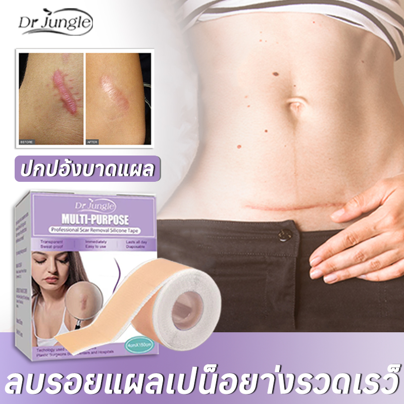 【จัดส่งจากกรุงเทพฯ】Dr.Jungle แผ่นแปะคีลอยด์ รักษารอยแผลเป็น  แผ่นแปะลบรอยแผลเป็น 4cm*150cm ลดรอยแผลเป็นนูน แผลคีลอยด์ แผลผ่าตัด คีลอยด์สิว แผ่นแปะซิลิโคนกำจัดรอยแผลเป็น ลดรอยแผลเป็นนูน แผลผ่าตัด