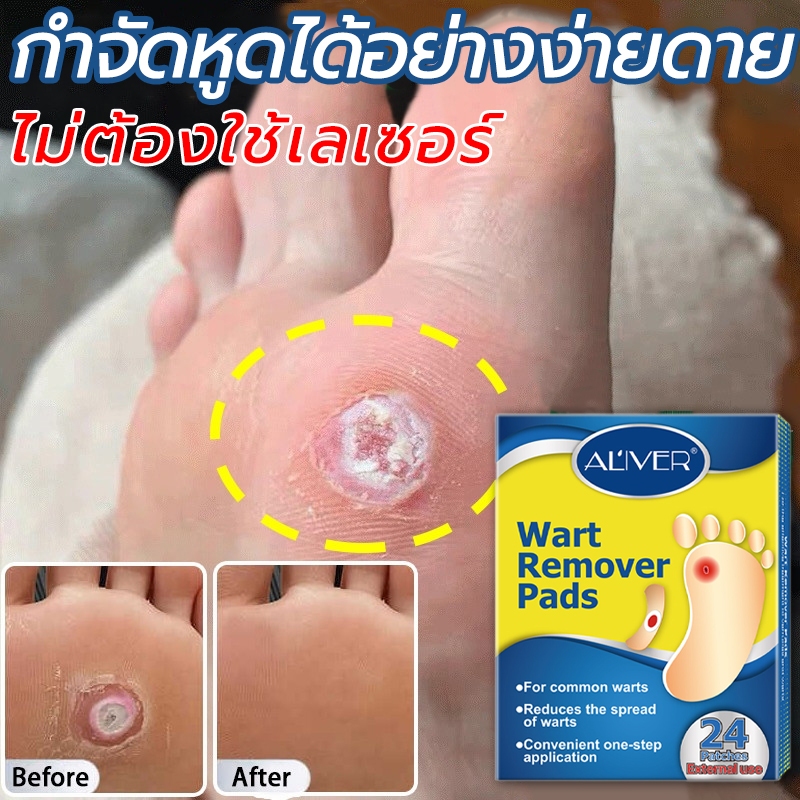 มีชีวิตอยู่ ผลิตภัณฑ์ดูแลเท้า 24ชิ้น/กล่อง สูตรดูแลผิวแข็ง ช่วยลดความแข็งของจุดสัมผัสของเท้า