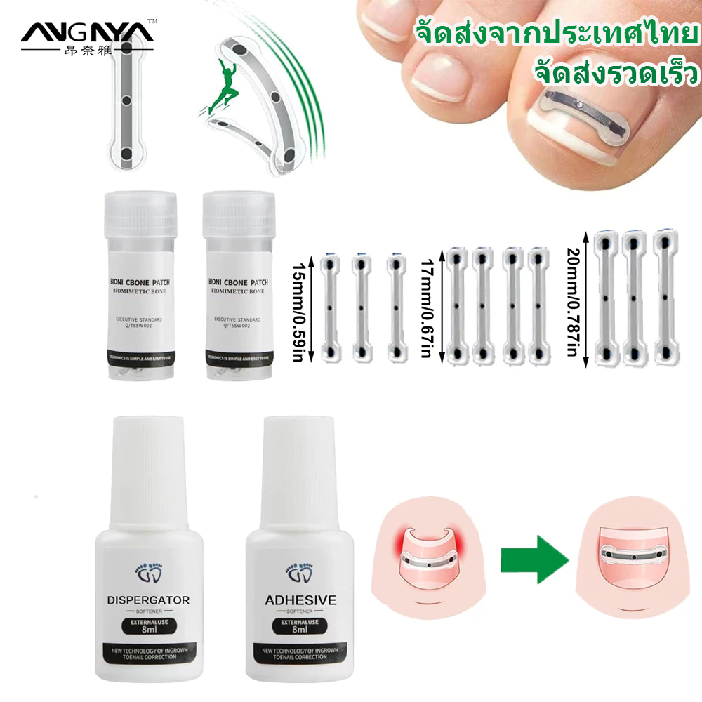 อังยา การรักษาเล็บเท้าคุดซิลิโคนไททาเนียมอัลลอยด์ออกแบบมาสําหรับการซ่อมเล็บโค้งและตัวแก้ไขเล็บเท้าคุด