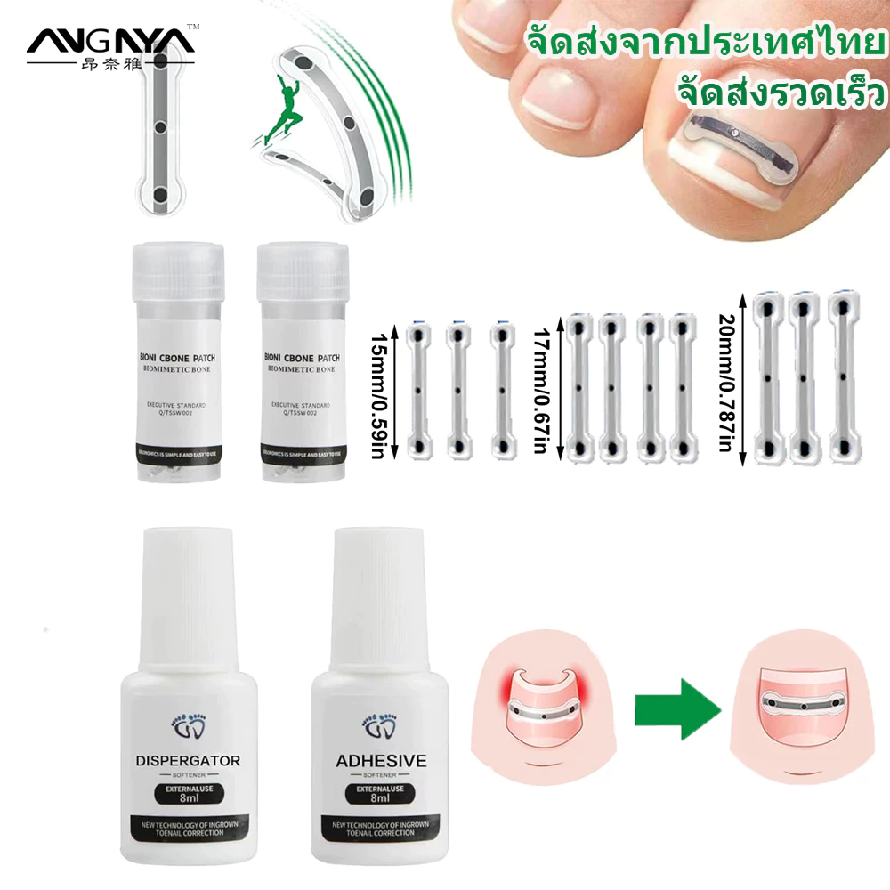 อังยา การรักษาเล็บเท้าคุดซิลิโคนไททาเนียมอัลลอยด์ออกแบบมาสําหรับการซ่อมเล็บโค้งและตัวแก้ไขเล็บเท้าคุด