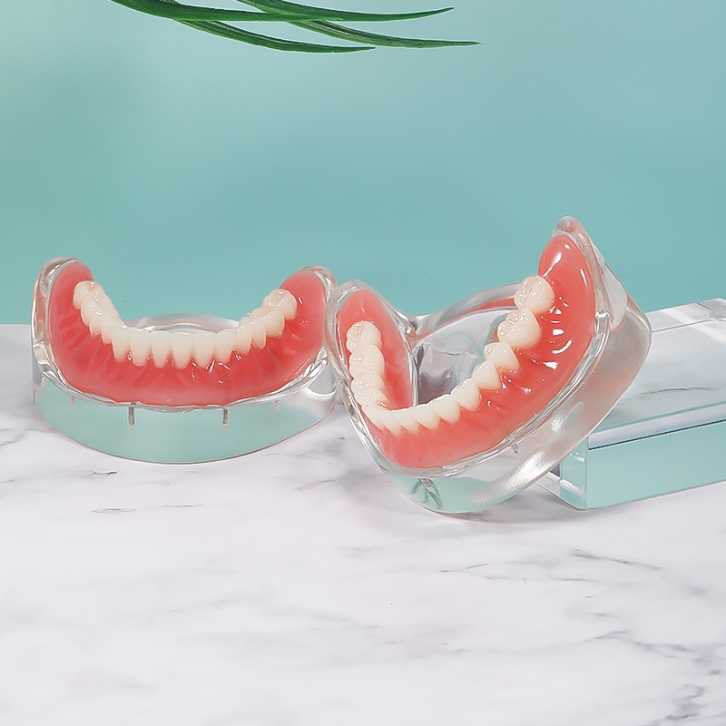 1 ชิ้นด้านบน/ต่ําทันตกรรม Implant รุ่นฟื้นฟู 4 Implants ฟันที่ถอดออกได้รุ่น Overdenture Typodont การสอน Demonstration