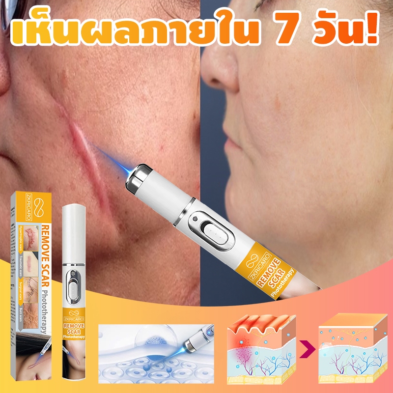 เกาหลี นําเข้าตัวชี้เลเซอร์สําหรับลบรอยแผลเป็นลดรอยแผลเป็นกําจัดรอยสิวลดรอยแตกลายเลเซอร์ลดรอยแผลเป็นรักษาแผลเป็นผ่าตัดกําม