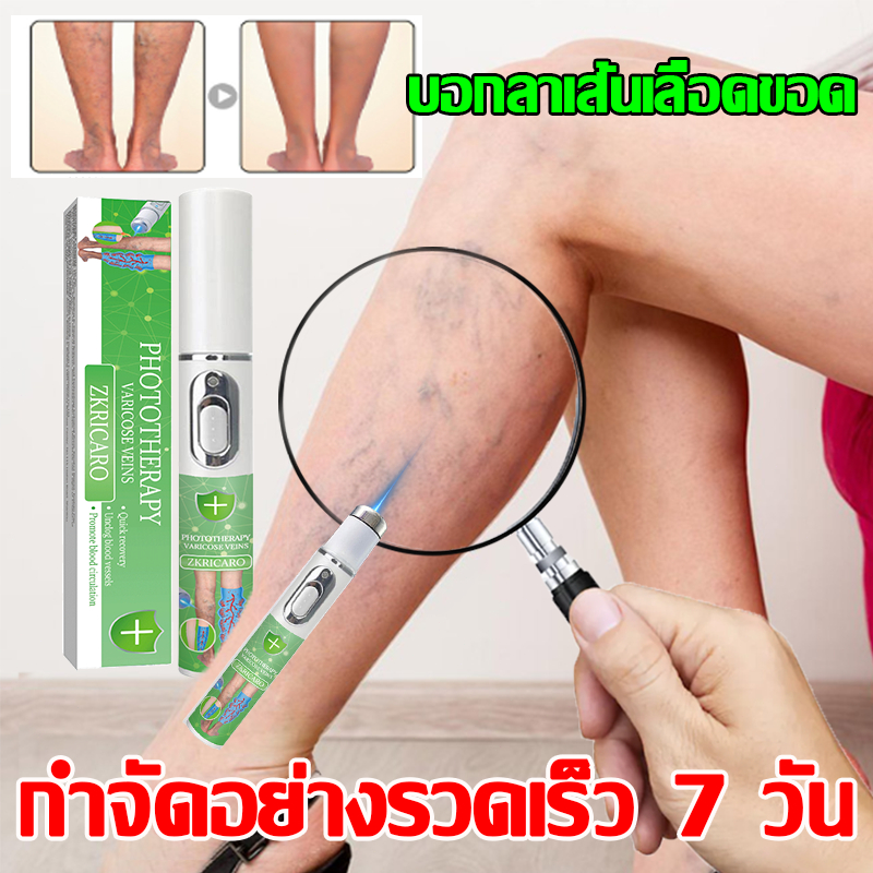 ปากกาเลเซอร์เส้นเลือดขอด รักษาเส้นเลือดขอด ลดเส้นเลือดขอด ลดอาการบวมขา