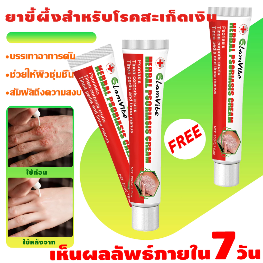 ครีมสะเก็ดเงิน ครีมต้านเชื้อรา ครีมแก้คัน แก้ผดผื่นคัน แก้การติดเชื้อรา ทาผิว ซ่อมผิว