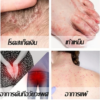 ครีมสะเก็ดเงิน ครีมต้านเชื้อรา ครีมแก้คัน แก้ผดผื่นคัน แก้การติดเชื้อรา ทาผิว ซ่อมผิว