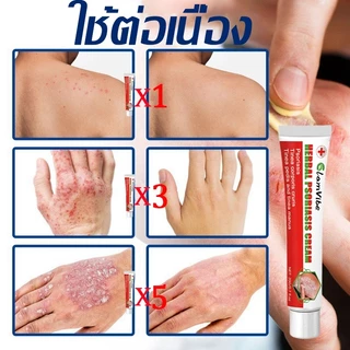 ครีมสะเก็ดเงิน ครีมต้านเชื้อรา ครีมแก้คัน แก้ผดผื่นคัน แก้การติดเชื้อรา ทาผิว ซ่อมผิว