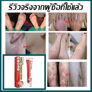 ครีมสะเก็ดเงิน ครีมต้านเชื้อรา ครีมแก้คัน แก้ผดผื่นคัน แก้การติดเชื้อรา ทาผิว ซ่อมผิว