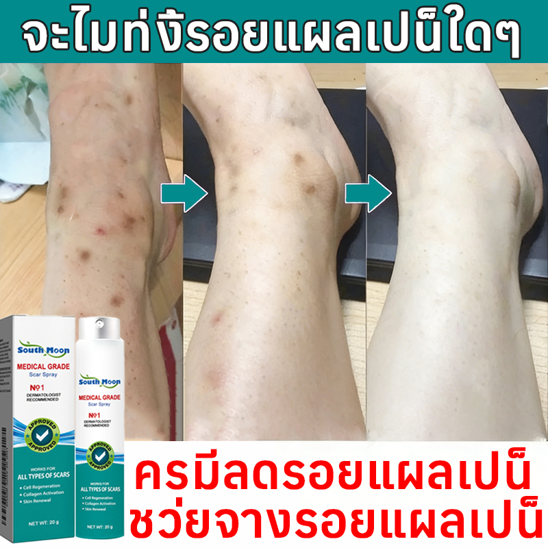 【COD】South Moon สเปรย์ลบรอยแผลเป็น 20g สเปรย์ดูแลแผลเป็น ป้องกันการติดเชื้อและรอยแผลเป็น
