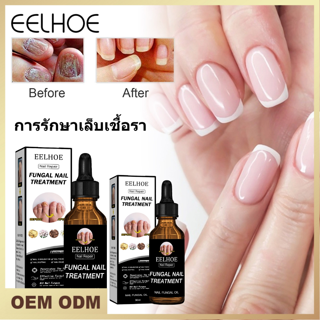 EELHOE เซรั่มฟื้นฟูเล็บเชื้อราป้องกันการติดเชื้อ Paronychia Onychomycosis คืนเล็บที่เสียหายสีไม่ดีมือเท้าเล็บเอสเซ้นส์