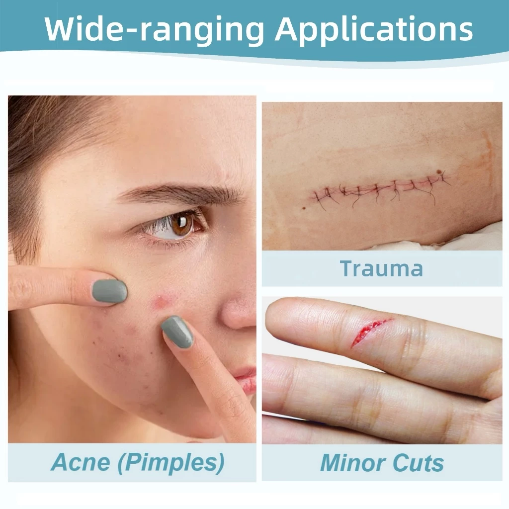 QUSTERE Hydrocolloid Acne Patch กันน้ําที่มองไม่เห็น Pimple Spot Patch สําหรับทุกสภาพผิว แผ่นแปะสิว thumbnail 4