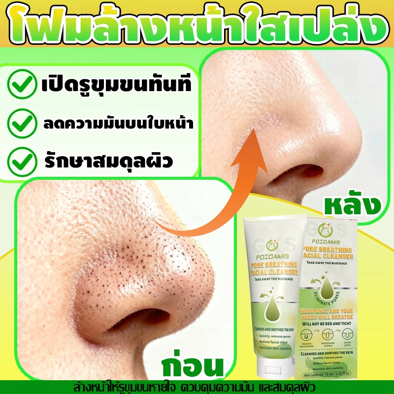 น้ํายาทําความสะอาดผิวหน้าปราบสิว ลบสิวหัวดํา รูขุมขนหดตัว ควบคุมความมันและลดสิว ปรับสีผิวให้กระจ่างใส ทําความสะอาดรูขุมขนอย่างล้ําลึก น้ํายาทําคว