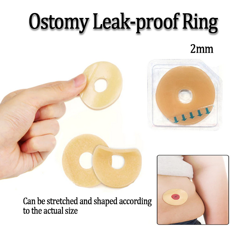 แหวนป้องกันการรั่วสําหรับถุงสร้างยืดหยุ่น ostomy ป้องกันเครื่องมือดูแลผิวกาว Ostomy
