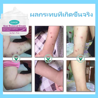 COD ของแท้ มลดรอยแผลเป็น แผลเป็น รแผลไฟไหม้ น้ำร้อนลว แผลผ่าตัด รอยแตกลายหลังครรภ์ แผลใหม่และแผลเป็นเก่า 50ml