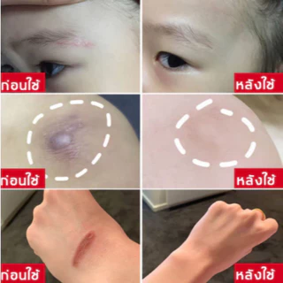 COD ของแท้ มลดรอยแผลเป็น แผลเป็น รแผลไฟไหม้ น้ำร้อนลว แผลผ่าตัด รอยแตกลายหลังครรภ์ แผลใหม่และแผลเป็นเก่า 50ml