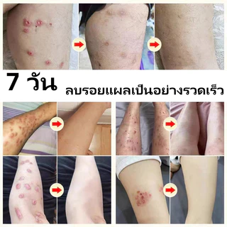 COD ของแท้ มลดรอยแผลเป็น แผลเป็น รแผลไฟไหม้ น้ำร้อนลว แผลผ่าตัด รอยแตกลายหลังครรภ์ แผลใหม่และแผลเป็นเก่า 50ml