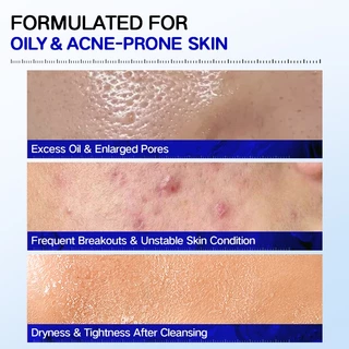 Rocean Salicylic Acid Exfoliating Cleanser 150g Oil Control Acne Treatment ทําความสะอาดล้ําลึกล้างหน้า