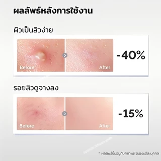 เอสเซนส์รักษาสิวไนอะซินาไมด์ กำจัดสิวได้อย่างมีประสิทธิภาพและรวดเร็ว บรรเทาอาการอักเสบ ลดรอยแผลเป็นจากสิว การควบคุมน้ำมัน การป้องกันการเกิดสิวซ้ำ Niacinamide Acne Treatment Serum Hiangel