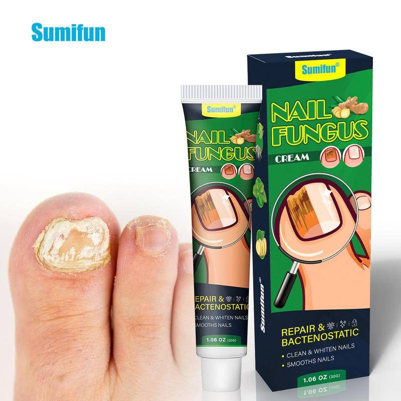 เจลรักษาเล็บป้องกันเชื้อรา – ซ่อมแซมเล็บอย่างมีประสิทธิภาพโดย Onychomycosis & Paronychia