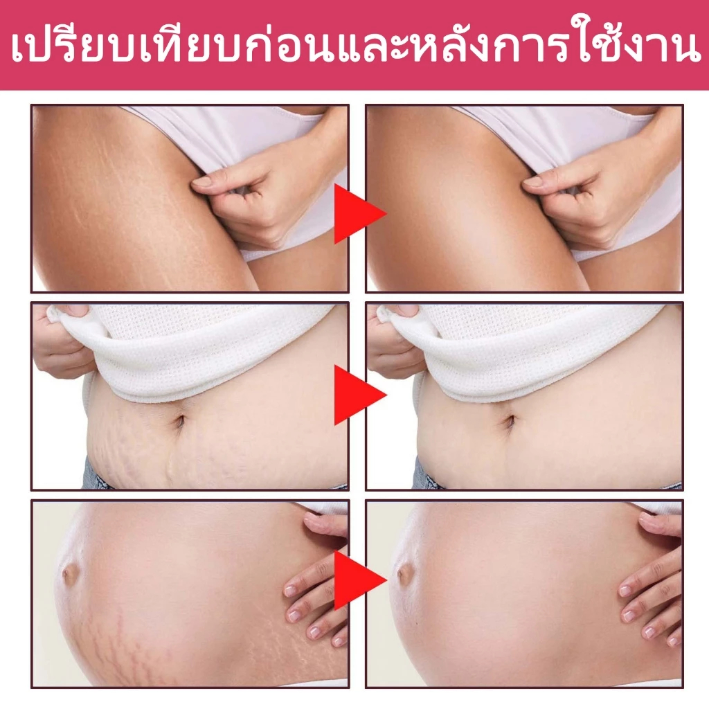 [รับประกันของแท้]Dr Jungle จังเกิลครีมทาท้องลาย 30ml  ครีมลดรอยแตกลายและ โลชั่นบำรุงผิวกาย Anti-Stretch Mark Cream ครีมทารอยแตกลาย มามาเบลล่า หน้าอกแตกลาย ท้องแตกลาย สำหรับคุณแม่. ราคา ถูกที่สุด ดีลบีเคเค แกลเลอรีภาพที่ 3