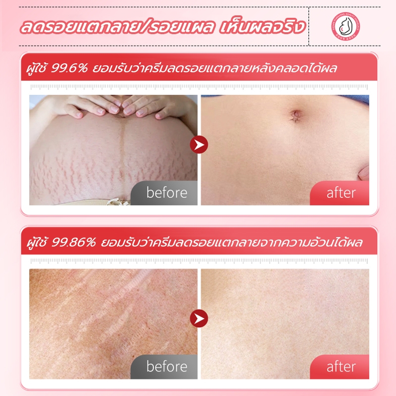 [รับประกันของแท้]Dr Jungle จังเกิลครีมทาท้องลาย 30ml  ครีมลดรอยแตกลายและ โลชั่นบำรุงผิวกาย Anti-Stretch Mark Cream ครีมทารอยแตกลาย มามาเบลล่า หน้าอกแตกลาย ท้องแตกลาย สำหรับคุณแม่. ราคา ถูกที่สุด ดีลบีเคเค แกลเลอรีภาพที่ 4