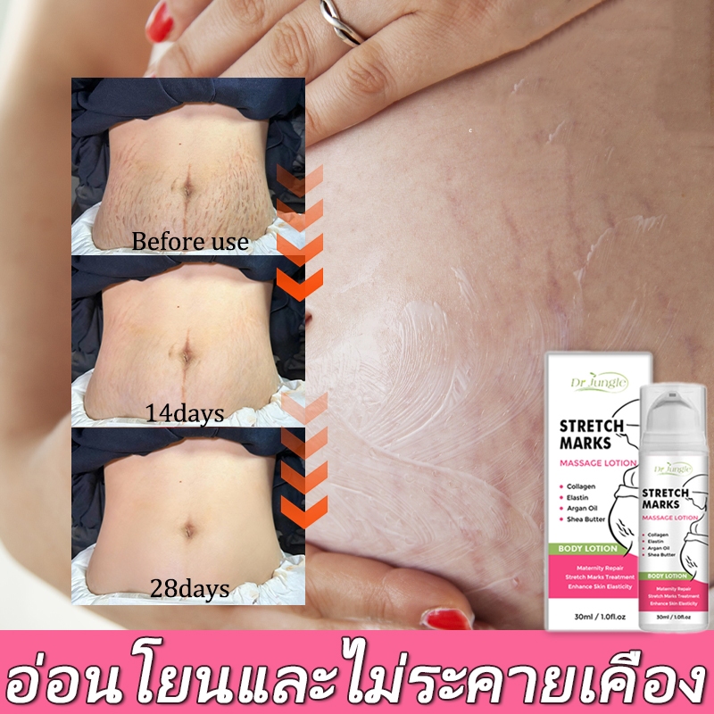 [รับประกันของแท้]Dr Jungle จังเกิลครีมทาท้องลาย 30ml  ครีมลดรอยแตกลายและ โลชั่นบำรุงผิวกาย Anti-Stretch Mark Cream ครีมทารอยแตกลาย มามาเบลล่า หน้าอกแตกลาย ท้องแตกลาย สำหรับคุณแม่. ราคา ถูกที่สุด ดีลบีเคเค