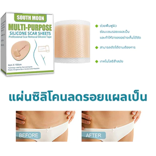✨ของแท้✨ South Moon แผ่นแปะลดรอยแผลเป็น ขนาด 4cm×150cm ช่วยลดรอยแผลเป็นนูน คีลอยด์ แผลผ่าตัด ฟื้นฟูผิวให้เรียบเนียน ดูจางลงเร็วขึ้นค่ะ