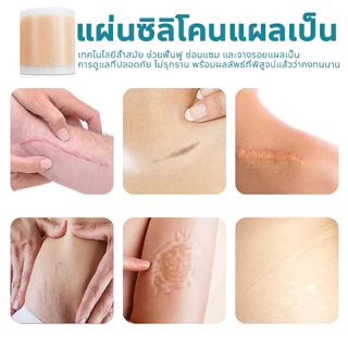 ✨ของแท้✨ South Moon แผ่นแปะลดรอยแผลเป็น ขนาด 4cm×150cm ช่วยลดรอยแผลเป็นนูน คีลอยด์ แผลผ่าตัด ฟื้นฟูผิวให้เรียบเนียน ดูจางลงเร็วขึ้นค่ะ