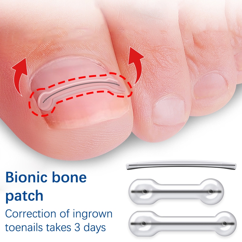 Zcx 2 ชิ้นคุด Toenail Correction เครื่องมือ Treatment Elastic Patch Pedicure เครื่องมือ VO