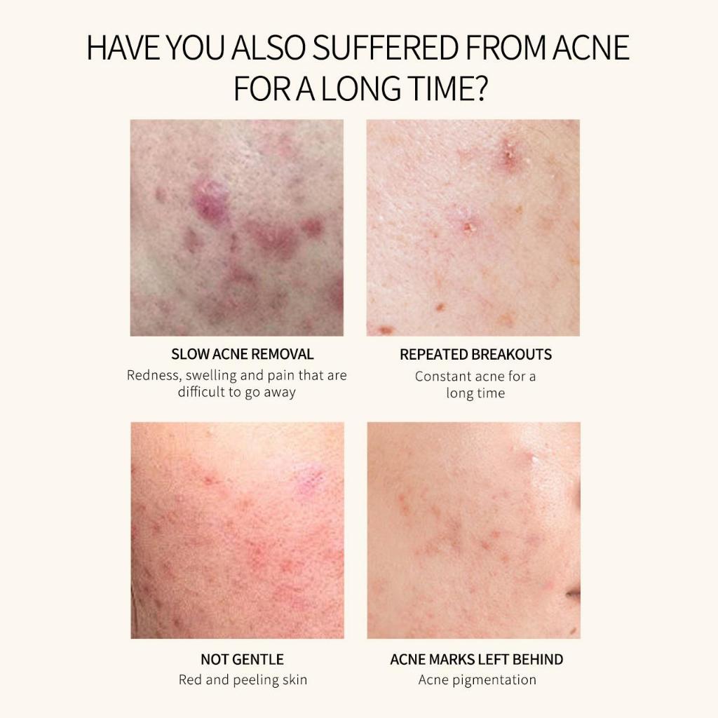 ZEESEA X MEDTALK Acne Spot Corrector Serum บรรเทาเร็ว 8H สําหรับสิวแดงและอักเสบ พร้อมคอมเพล็กซ์ป้องกันสิว 35% & Niacinamide สูตร Zero Added — صورة 2