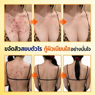 เจลอาบน้ำป้องกันไรฝุ่นกำมะถัน ครีมอาบน้ำกำจัดไร ครีมอาบน้ําลดสิว 500ml กำจัดไรลดสิว แก้คัน ลดการสะสมของแบคทีเรี
