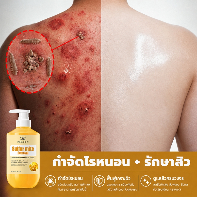 เจลอาบน้ำป้องกันไรฝุ่นกำมะถัน ครีมอาบน้ำกำจัดไร กำจัดไรลดสิว ต่อต้านเชื้อราแก้คัน ลดการสะสมของแบคทีเรีย 99.8% 500ml
