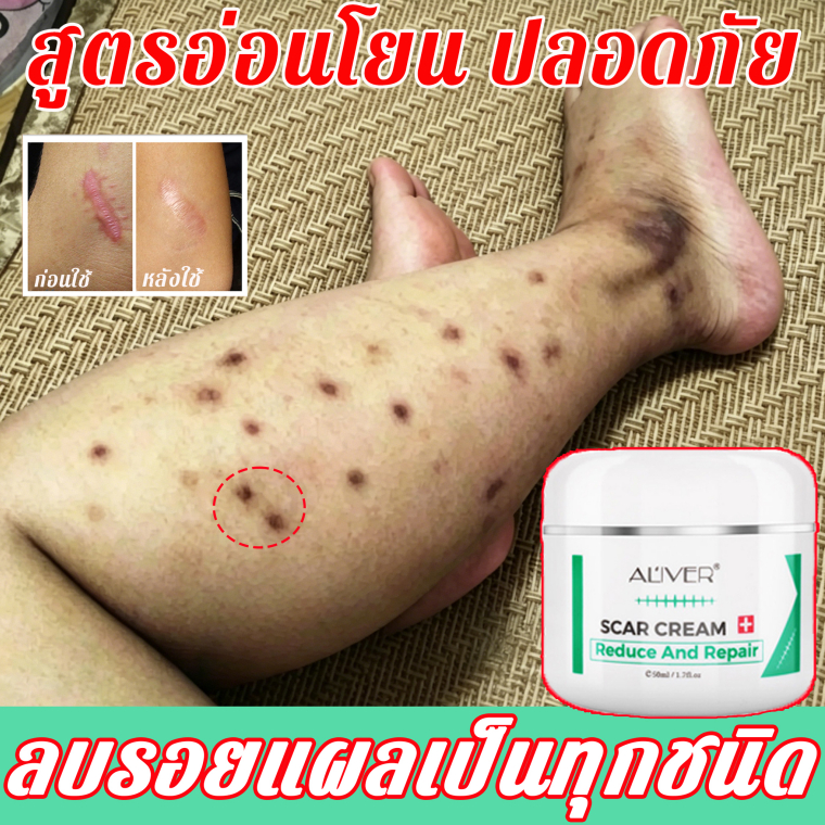 【ของแท้ 100%🔥】ALIVER ครีมลบรอยแผลเป็น แผลไฟไหม้ 50ml ช่วยลดรอยแผลเป็นจากสิว และรอยแผลหลังคลอดได้อย่างมีประสิทธิภาพ รอยแตกลาย ช่วยให้แผลเป็นหาย ครีมทาแผลเป็น ครีมกำจัดรอยแผลเป็น
