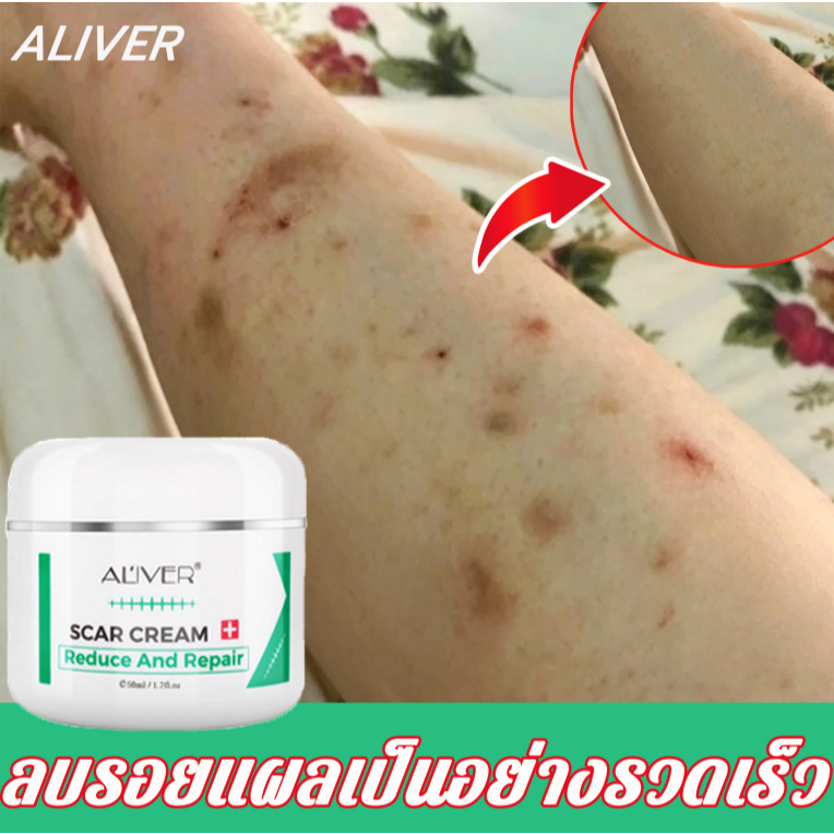 【ของแท้ 100%🔥】ALIVER ครีมลบรอยแผลเป็น แผลไฟไหม้ 50ml ช่วยลดรอยแผลเป็นจากสิว และรอยแผลหลังคลอดได้อย่างมีประสิทธิภาพ รอยแตกลาย ช่วยให้แผลเป็นหาย ครีมทาแผลเป็น ครีมกำจัดรอยแผลเป็น