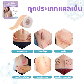 【ของแท้ 100%🔥】Dr.Jungle แผ่นแปะลบแผลเป็น 4*150cmรักษาแผลเป็น ใช้สำหรับลบด่างดำ scar silicone แผ่นแปะลบรอยด่างดำ ออกฤทธิ์เร็วและมีประสิทธิภาพในการกำจัดรอยด่างดำและรอยแผลเป็น