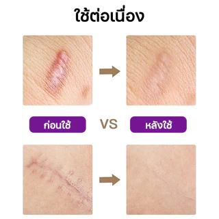 【ของแท้ 100%🔥】Dr.Jungle แผ่นแปะลบแผลเป็น 4*150cmรักษาแผลเป็น ใช้สำหรับลบด่างดำ scar silicone แผ่นแปะลบรอยด่างดำ ออกฤทธิ์เร็วและมีประสิทธิภาพในการกำจัดรอยด่างดำและรอยแผลเป็น