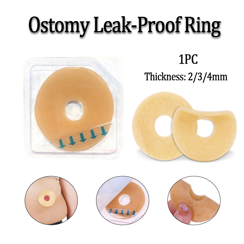 Moldable Ostomy Barrier แหวนป้องกันการรั่วไหลแชสซีซีลแหวนสําหรับ Colosstomy Skin Protection