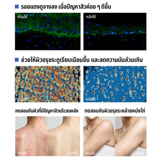 ICE LERSKIN Acne Clear Body Acne Spray สเปรย์ลดสิวผิวกาย สเปรย์ฉีดสิว ฆ่าเชื้อสิว และลดการเกิด ใช้ได้ทั้งหน้า และลำตัว