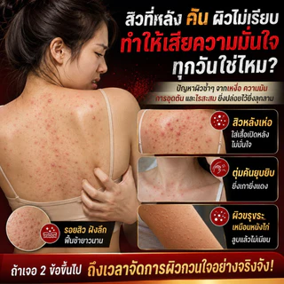 ครีมอาบน้ำซัลเฟอร์ทำความสะอาดล้ำลึก กำจัดไรฝุ่นและแก้คัน ช่วยลดสิวหลังและรูขุมขนอักเสบอย่างเห็นผลจริง สูตรอ่อนโยนเหมาะกับผิวบอบบางแพ้ง่าย ขนาดสุดคุ้ม 500 มล