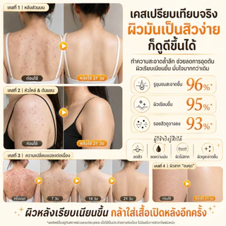ครีมอาบน้ำซัลเฟอร์ทำความสะอาดล้ำลึก กำจัดไรฝุ่นและแก้คัน ช่วยลดสิวหลังและรูขุมขนอักเสบอย่างเห็นผลจริง สูตรอ่อนโยนเหมาะกับผิวบอบบางแพ้ง่าย ขนาดสุดคุ้ม 500 มล