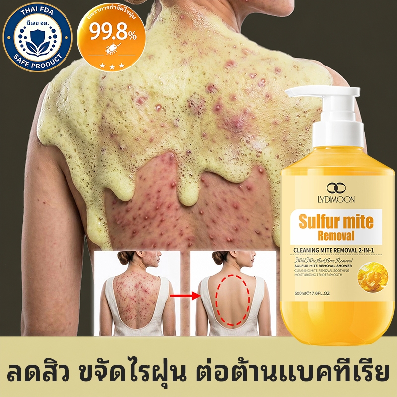 LYDIMOON เจลอาบน้ำป้องกันไรฝุ่นกำมะถัน ครีมอาบน้ําลดสิว 500ml ต่อต้านเชื้อราแก้คัน กำจัดไรลดสิว ลดการสะสมของแบคทีเรีย 99.8% ให้ความชุ่มชื้นอ่อนโยน