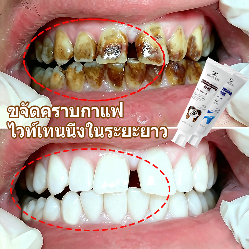 LYDIMOON ยาสีฟันไวท์เทนนิ่ง , ฟันขาว  ฟอกสีฟัน ยาสีฟันขจัดคราบบุหรี่ ดื่มชา กาแฟ ลมหายใจสดชื่น   กำจ