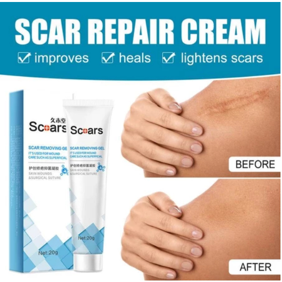 SCAR Removal Cream Treatment Removing Gel Stretch Marks Acne Scar Serum Repair Cream Skin Wounds