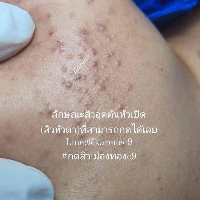 ปลายเรียบ ที่กดสิว ไม้กดสิว ไม่บาดผิว ❗ คุ้มค่า Karene พร้อมส่ง 1ชิ้น แถมฟรี ที่เปิดหัวสิวเลือกจำนวน