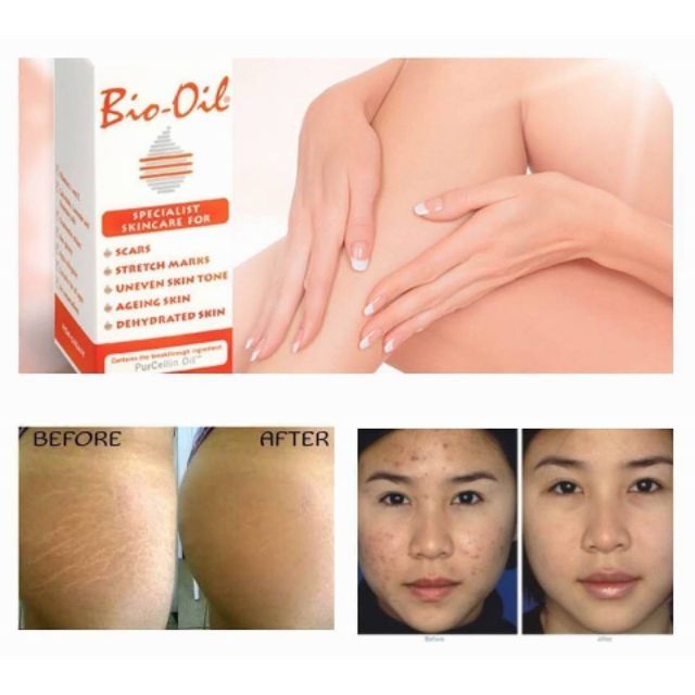 Bio Oil ไบโอ-ออยล์ ออยสารพัดประโยชน์ ลบรอยแผลเป็น ผิวแตกลาย bio-oil