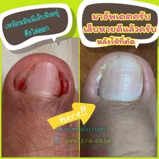 แซะซอกเล็บ ตัดเล็บขบ แบบเปลี่ยนใบมีด เลาะเล็บขบสำหรับมืออาชีพ