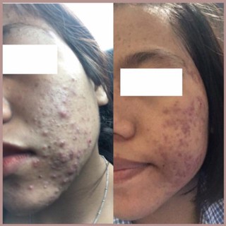 the labatorian acne serum