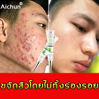 Aichunครีมรักษาสิว30ml ลบรอยสิวและรอยสิวได้อย่างมีประสิทธิภาพโดยไม่ทิ้งรอย ครีมแต้มสิว ผลิตภัณฑ์รักษาสิว ครีมรักษาหลุมสิ