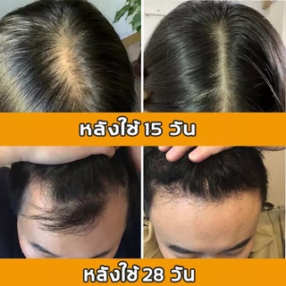 ป้องกันผมร่วง+เซรั่มปลูก แชมพูแก้ผมร่วง  แชมพูขิง 400MLแชมพูสมุนไพร แชมพูเร่งผมยาว แชมพูชายหญิง เซรั่มปลูกผม